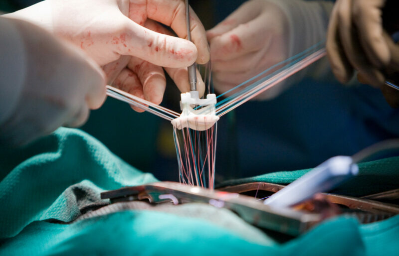 Close up of heart procedure