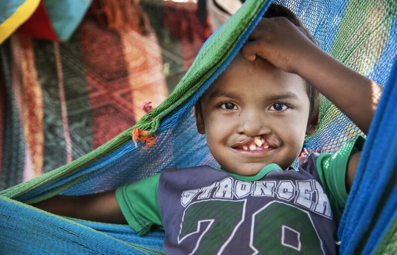 A young boy with a cleft lip rests in his hammock.