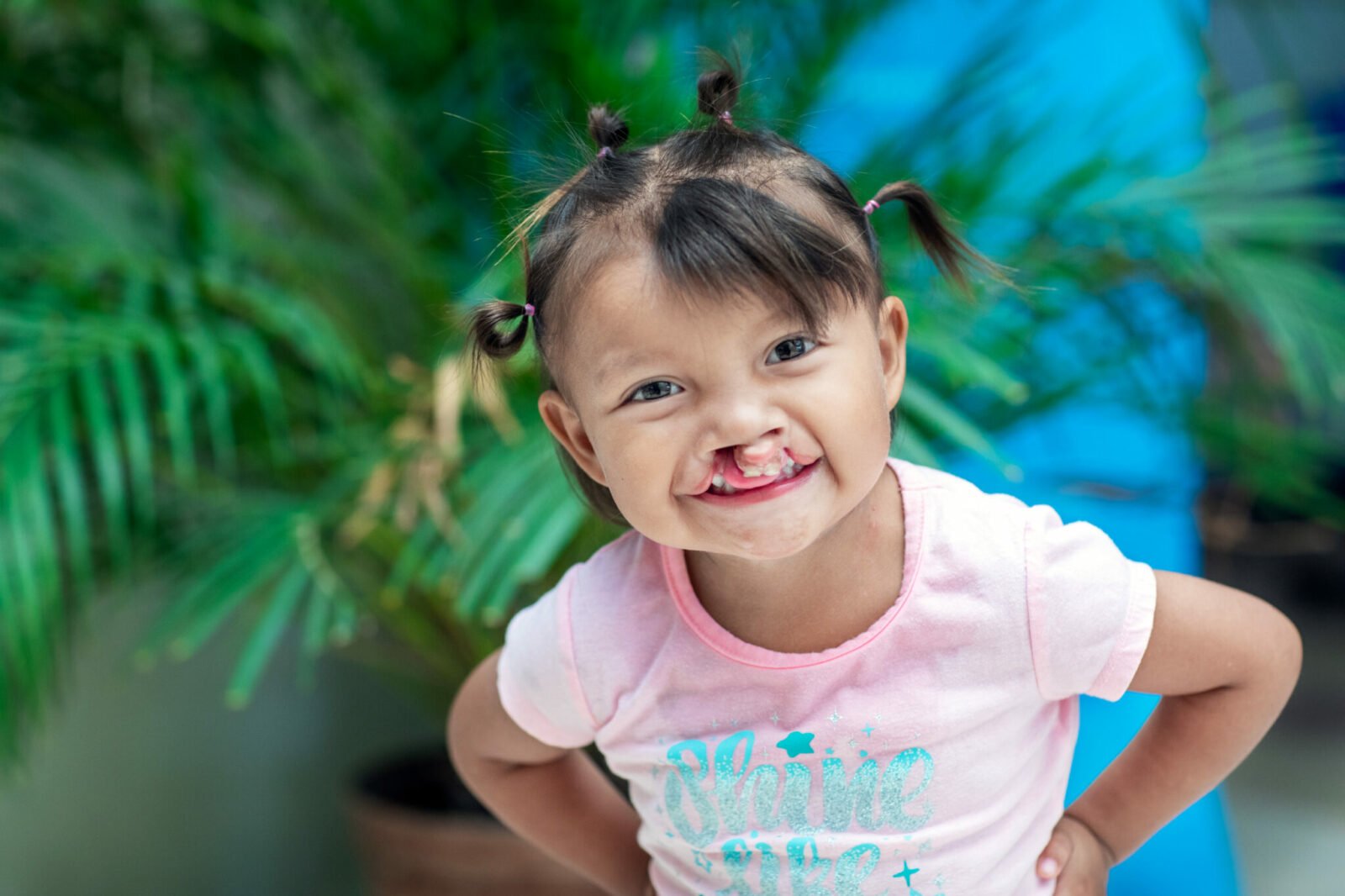 A toddler from Mexico with a cleft lip smiles at the camera. She is wearing pink and has four pigtails in her hair.